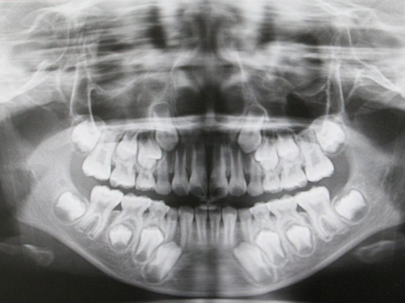 頭部X線規格写真（セファログラム）を用いた、より精密で正確な矯正治療をいたします