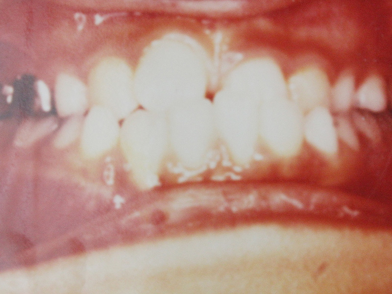 下顎前突（受け口）