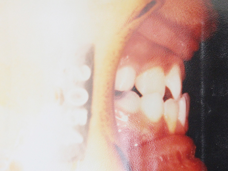 下顎前突（受け口）