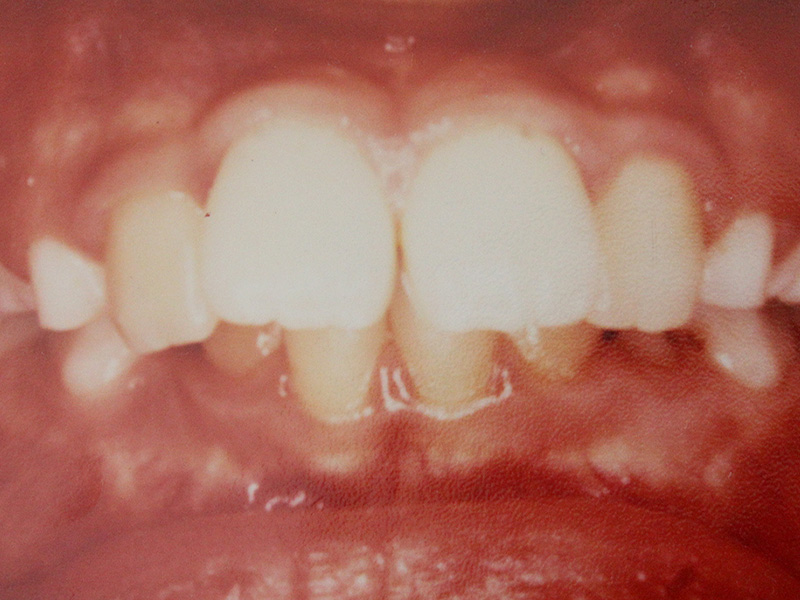 上顎前突（出っ歯）