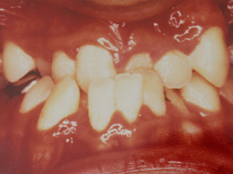 叢生（乱杭歯）